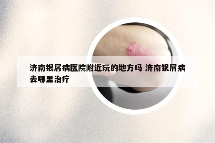 济南银屑病医院附近玩的地方吗 济南银屑病去哪里治疗