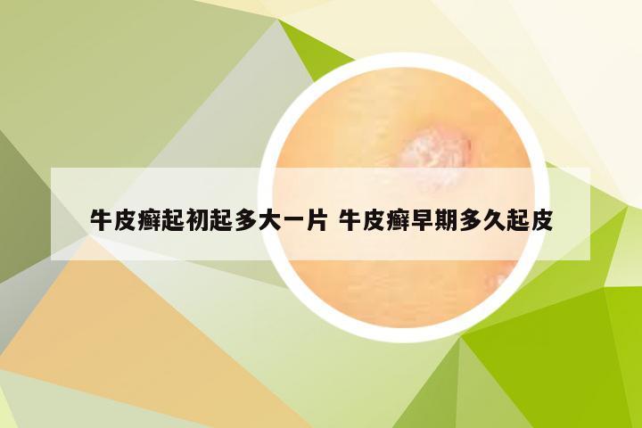 牛皮癣起初起多大一片 牛皮癣早期多久起皮