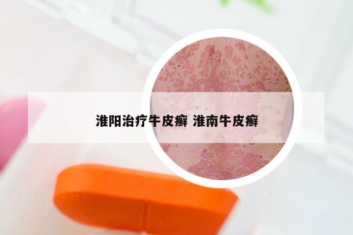 淮阳治疗牛皮癣 淮南牛皮癣