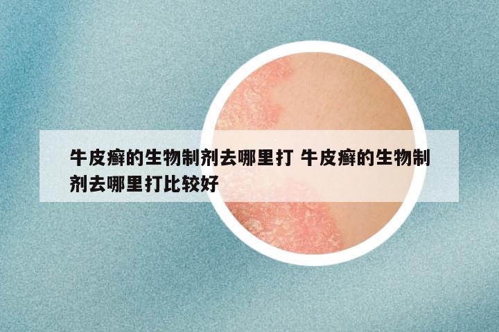 牛皮癣的生物制剂去哪里打 牛皮癣的生物制剂去哪里打比较好