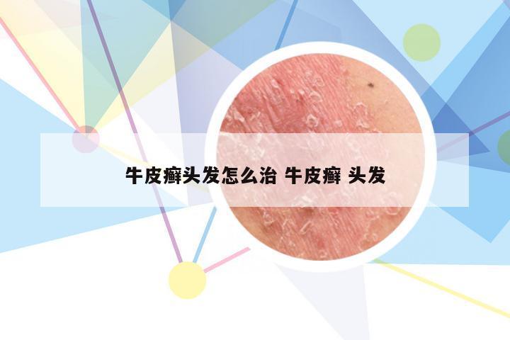 牛皮癣头发怎么治 牛皮癣 头发