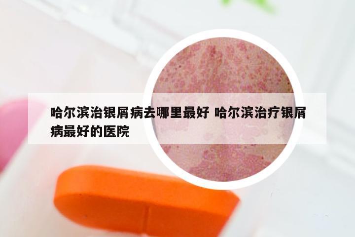 哈尔滨治银屑病去哪里最好 哈尔滨治疗银屑病最好的医院