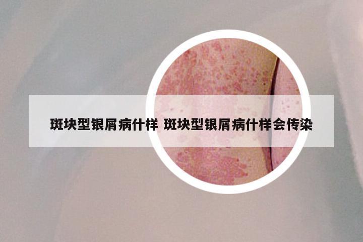 斑块型银屑病什样 斑块型银屑病什样会传染