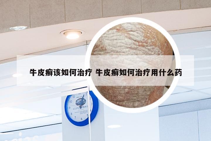 牛皮癣该如何治疗 牛皮癣如何治疗用什么药