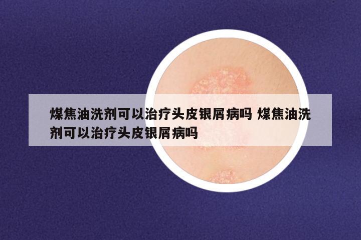 煤焦油洗剂可以治疗头皮银屑病吗 煤焦油洗剂可以治疗头皮银屑病吗