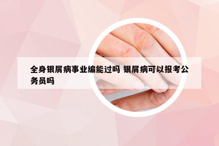 全身银屑病事业编能过吗 银屑病可以报考公务员吗