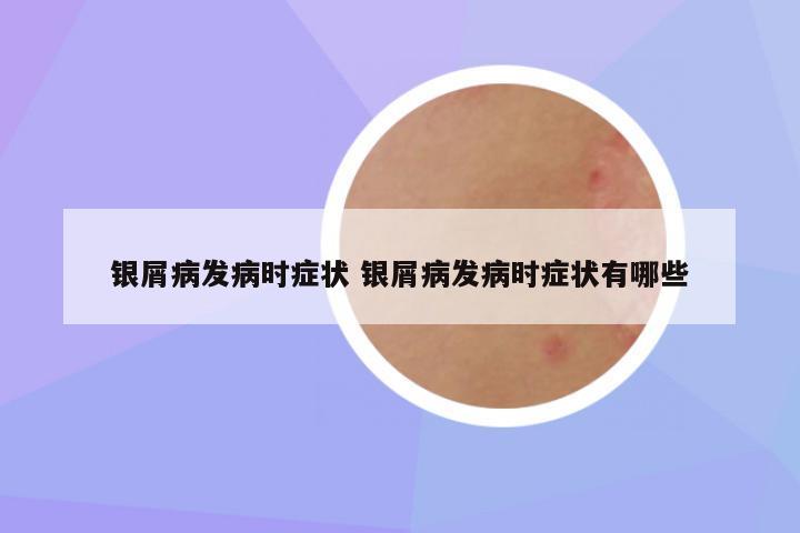 银屑病发病时症状 银屑病发病时症状有哪些