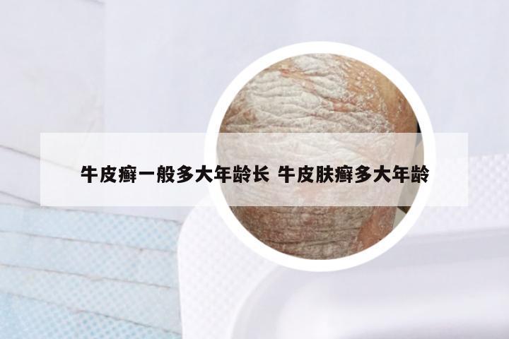 牛皮癣一般多大年龄长 牛皮肤癣多大年龄