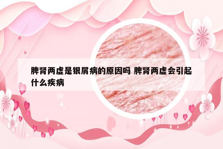 脾肾两虚是银屑病的原因吗 脾肾两虚会引起什么疾病