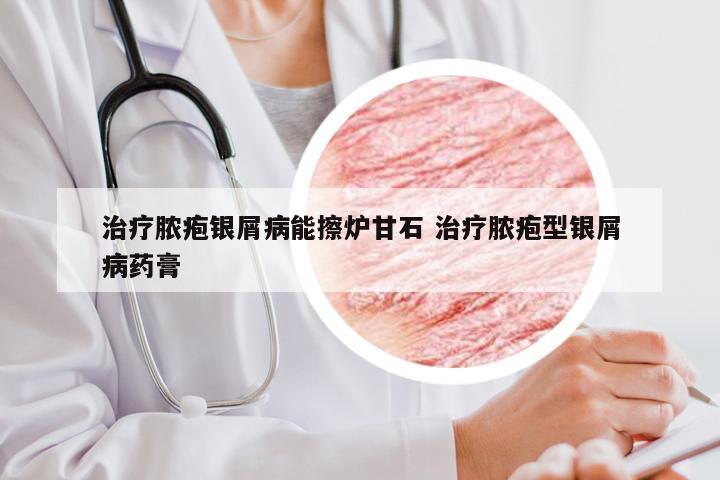 治疗脓疱银屑病能擦炉甘石 治疗脓疱型银屑病药膏