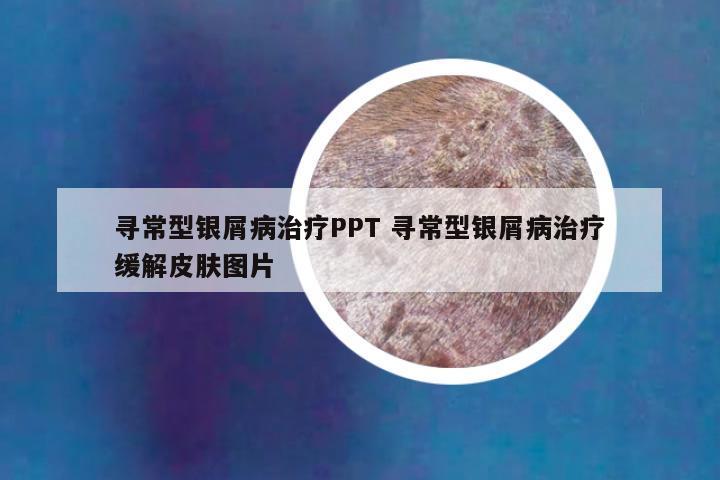 寻常型银屑病治疗PPT 寻常型银屑病治疗缓解皮肤图片