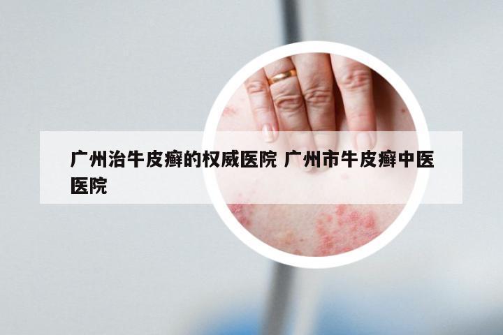 广州治牛皮癣的权威医院 广州市牛皮癣中医医院