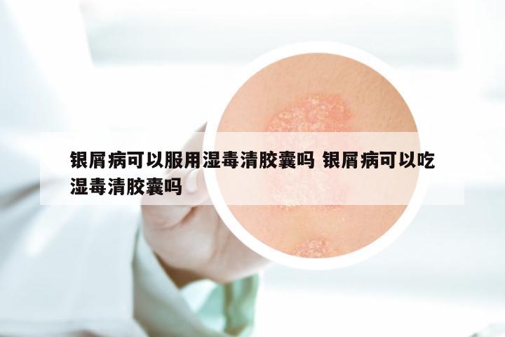 银屑病可以服用湿毒清胶囊吗 银屑病可以吃湿毒清胶囊吗