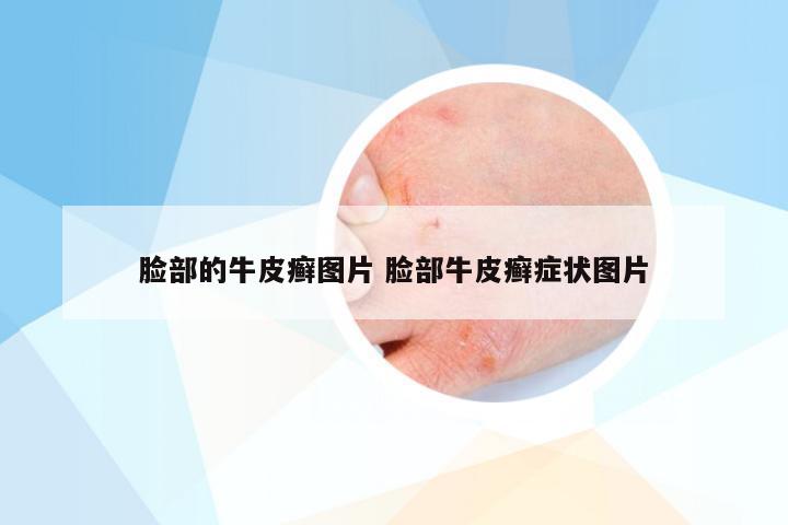 脸部的牛皮癣图片 脸部牛皮癣症状图片