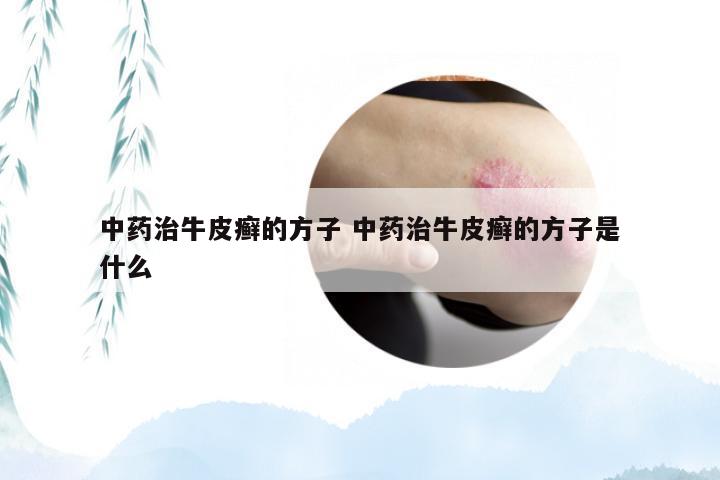 中药治牛皮癣的方子 中药治牛皮癣的方子是什么