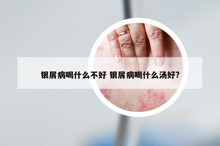 银屑病喝什么不好 银屑病喝什么汤好?
