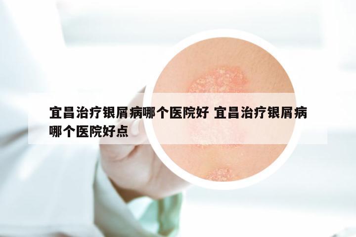宜昌治疗银屑病哪个医院好 宜昌治疗银屑病哪个医院好点