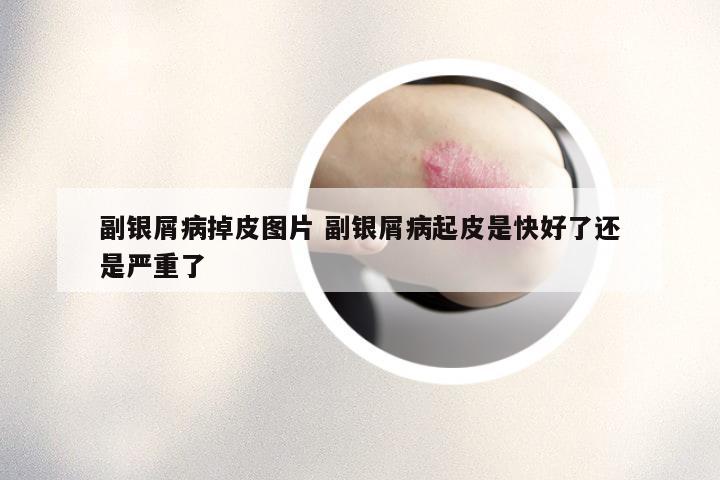 副银屑病掉皮图片 副银屑病起皮是快好了还是严重了