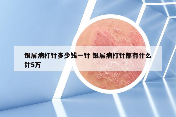 银屑病打针多少钱一针 银屑病打针都有什么针5万