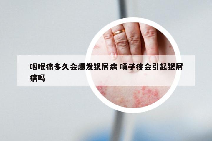 咽喉痛多久会爆发银屑病 嗓子疼会引起银屑病吗