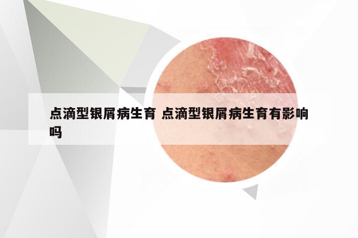 点滴型银屑病生育 点滴型银屑病生育有影响吗