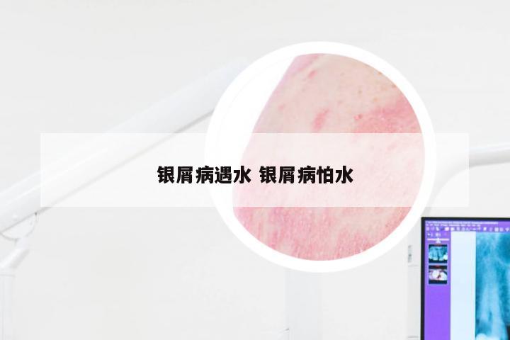 银屑病遇水 银屑病怕水