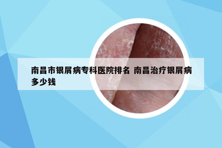 南昌市银屑病专科医院排名 南昌治疗银屑病多少钱