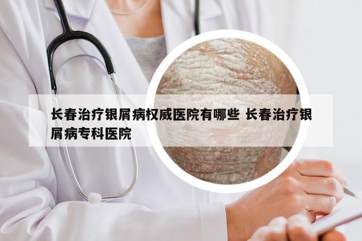 长春治疗银屑病权威医院有哪些 长春治疗银屑病专科医院