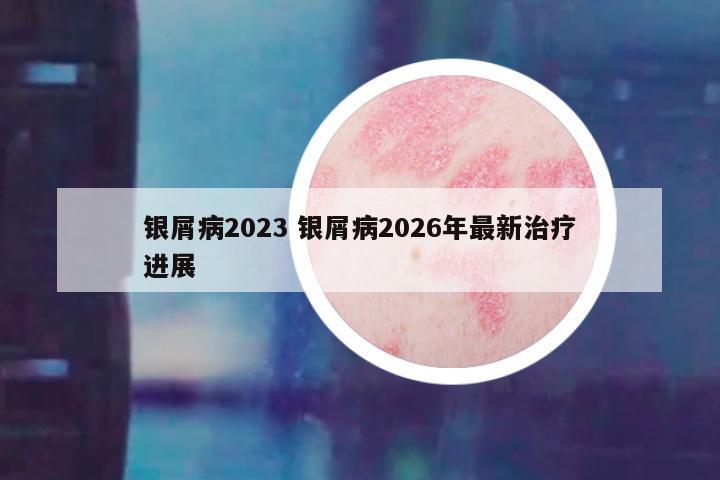 银屑病2023 银屑病2026年最新治疗进展