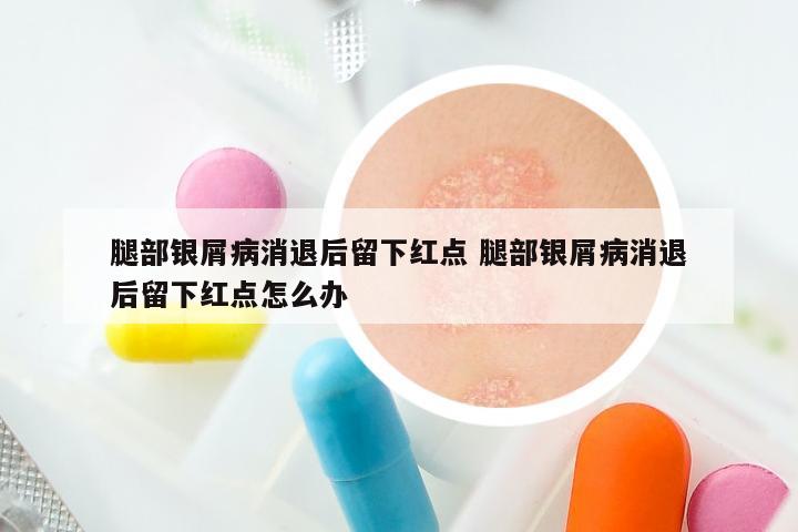 腿部银屑病消退后留下红点 腿部银屑病消退后留下红点怎么办
