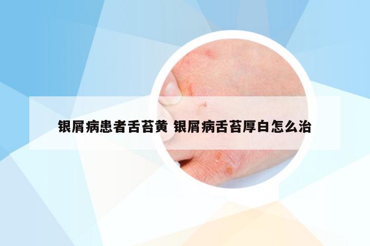 银屑病患者舌苔黄 银屑病舌苔厚白怎么治