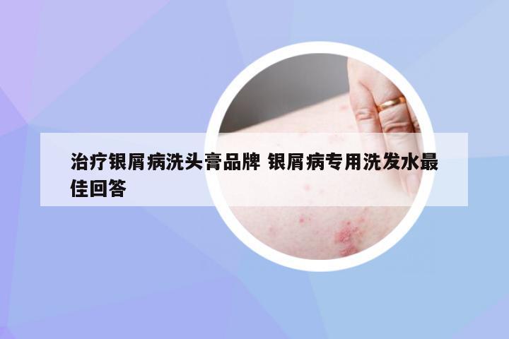 治疗银屑病洗头膏品牌 银屑病专用洗发水最佳回答