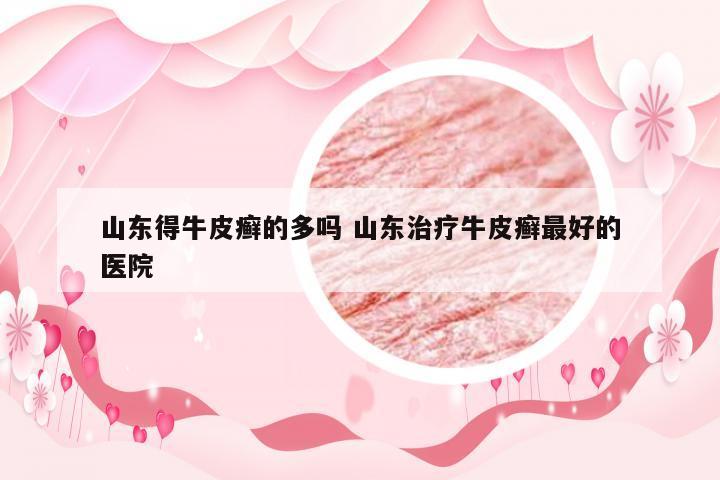 山东得牛皮癣的多吗 山东治疗牛皮癣最好的医院