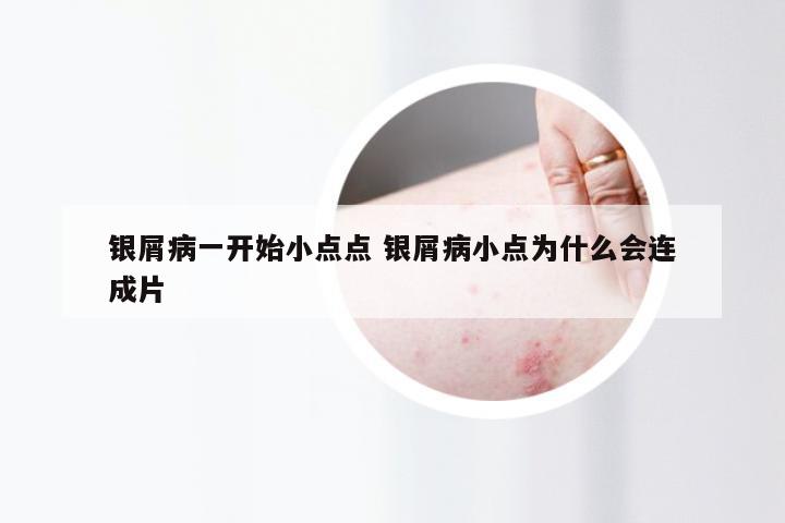 银屑病一开始小点点 银屑病小点为什么会连成片
