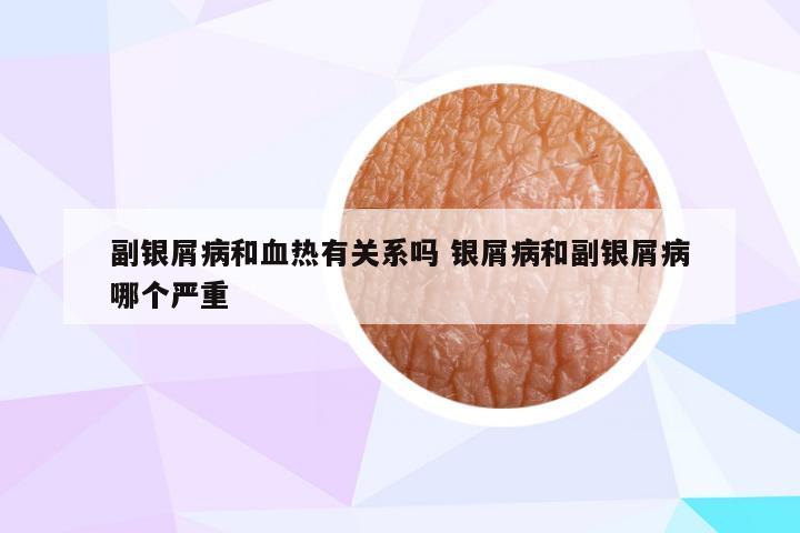 副银屑病和血热有关系吗 银屑病和副银屑病哪个严重