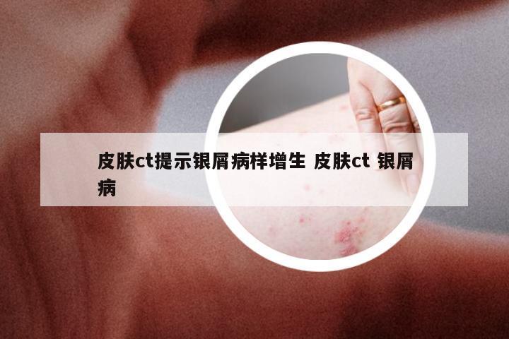 皮肤ct提示银屑病样增生 皮肤ct 银屑病