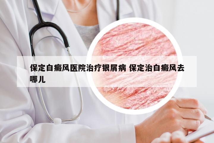 保定白癜风医院治疗银屑病 保定治白癜风去哪儿