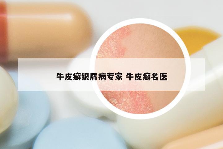 牛皮癣银屑病专家 牛皮癣名医
