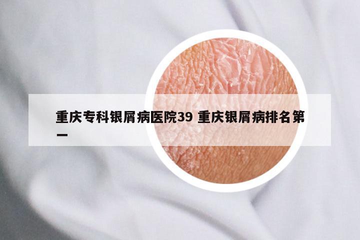 重庆专科银屑病医院39 重庆银屑病排名第一