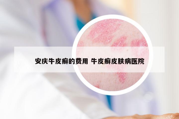 安庆牛皮癣的费用 牛皮癣皮肤病医院