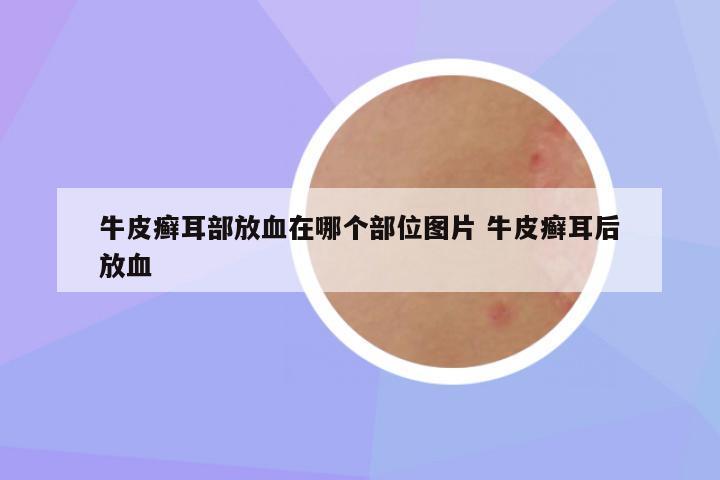 牛皮癣耳部放血在哪个部位图片 牛皮癣耳后放血