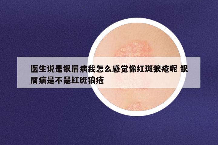 医生说是银屑病我怎么感觉像红斑狼疮呢 银屑病是不是红斑狼疮