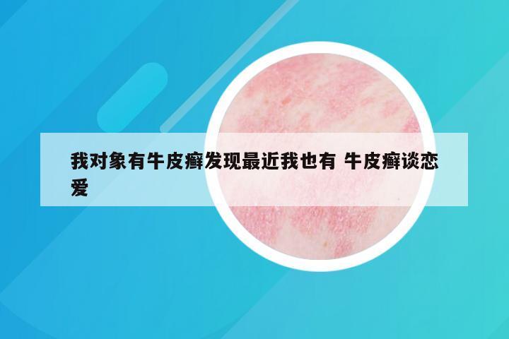 我对象有牛皮癣发现最近我也有 牛皮癣谈恋爱
