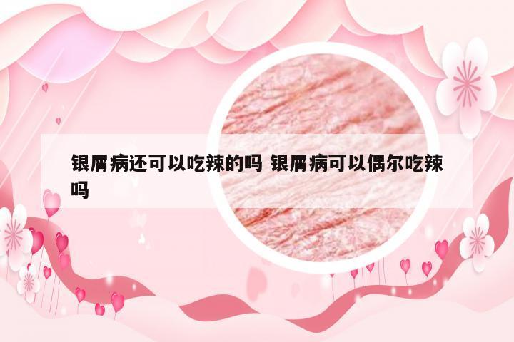 银屑病还可以吃辣的吗 银屑病可以偶尔吃辣吗