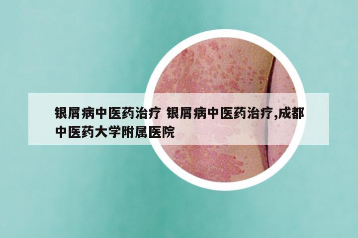 银屑病中医药治疗 银屑病中医药治疗,成都中医药大学附属医院