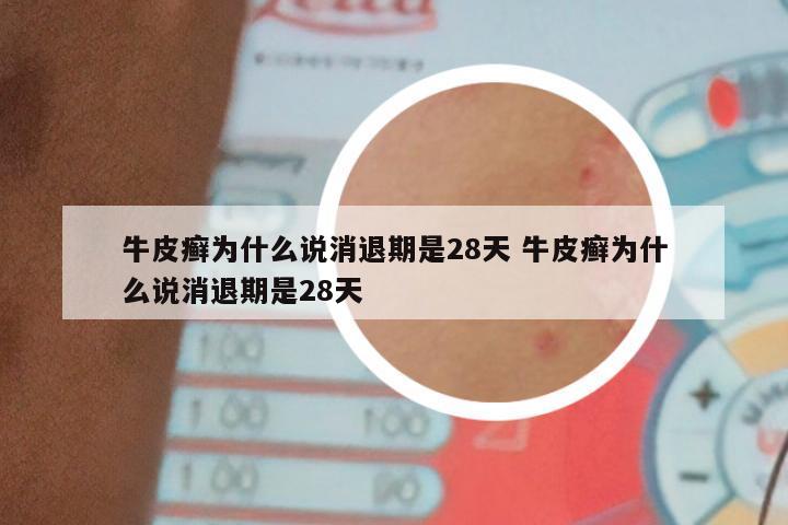 牛皮癣为什么说消退期是28天 牛皮癣为什么说消退期是28天