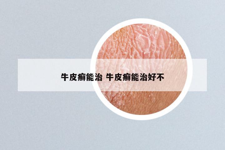 牛皮癣能治 牛皮癣能治好不