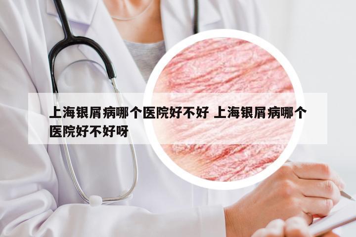 上海银屑病哪个医院好不好 上海银屑病哪个医院好不好呀