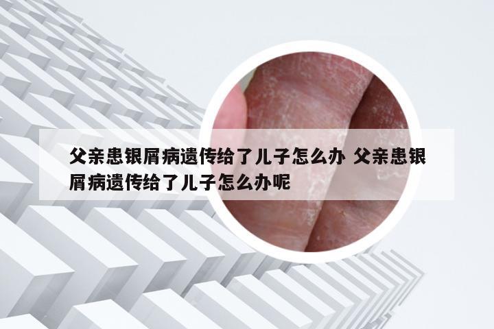 父亲患银屑病遗传给了儿子怎么办 父亲患银屑病遗传给了儿子怎么办呢