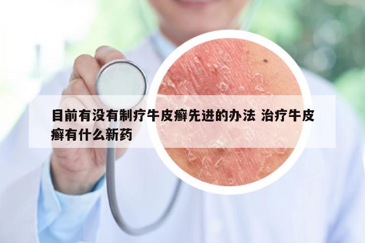 目前有没有制疗牛皮癣先进的办法 治疗牛皮癣有什么新药